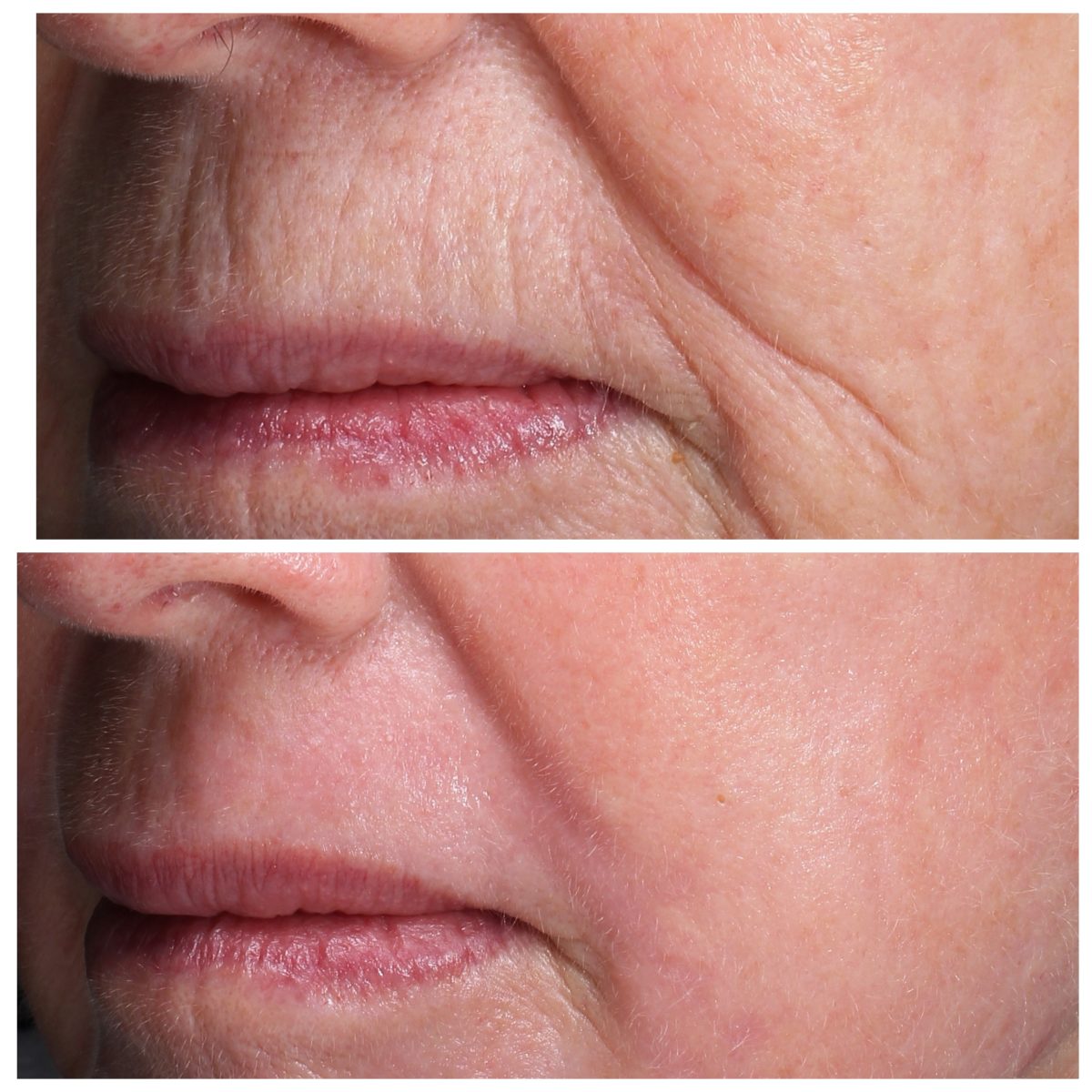 Laser Treatments & Facial Resurfacing Clinic in Exeter & Plymouth